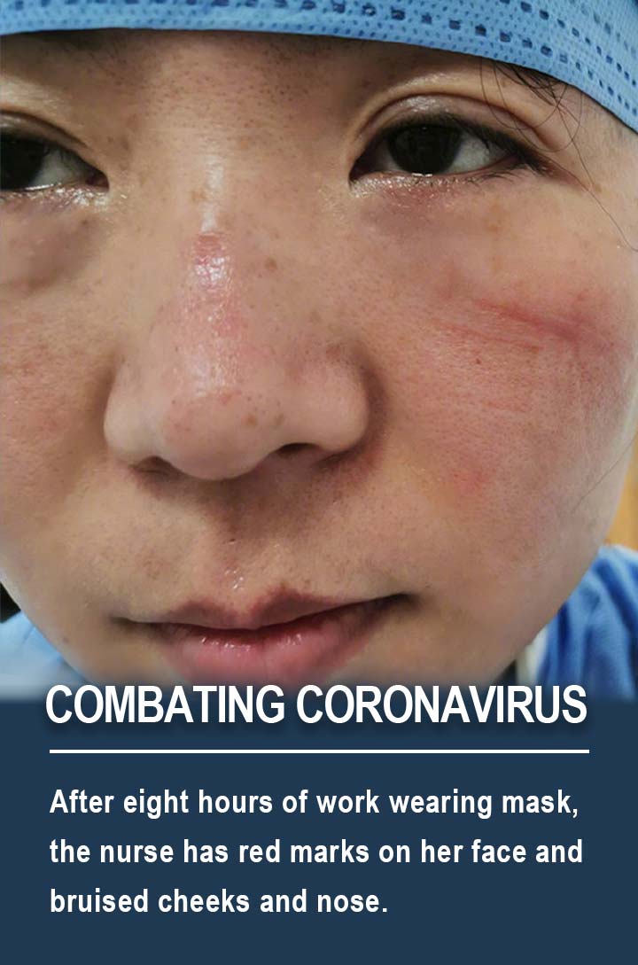 After eight hours of work wearing mask, the nurse has red marks on her face and bruised cheeks and nose.