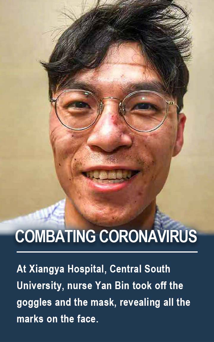 At Xiangya Hospital, Central South University, nurse Yan Bin took off the goggles and the mask, revealing all the marks on the face.